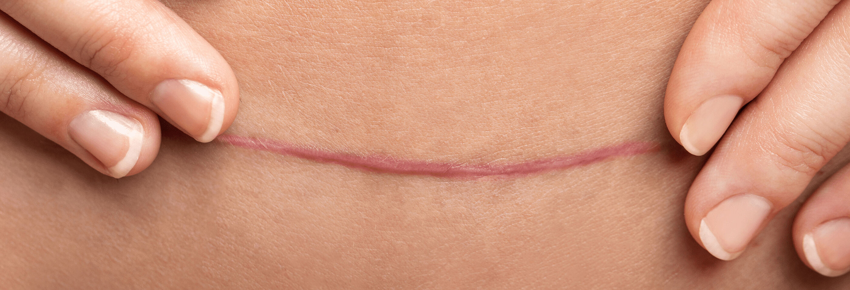 Crème pour les cicatrices